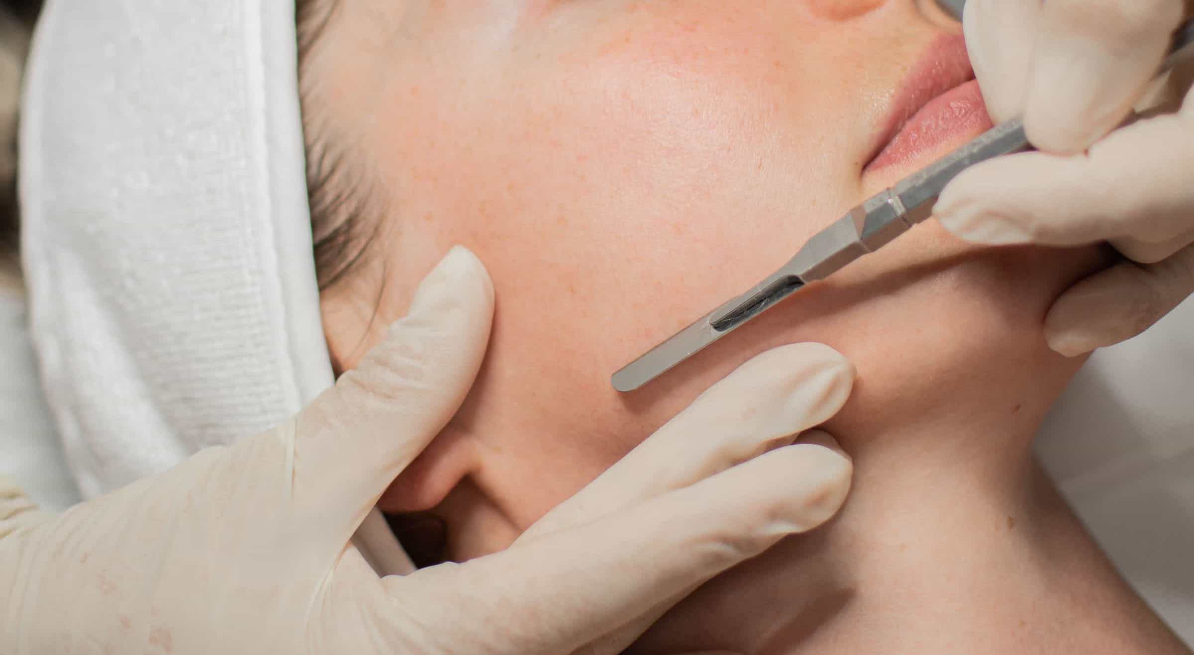 Why You Need to Try Dermaplaning